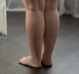 휜다리 증상 확인